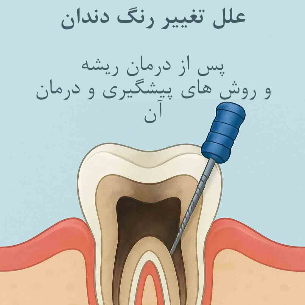 Tooth Discoloration After Root Canal | Causes and Treatment Options