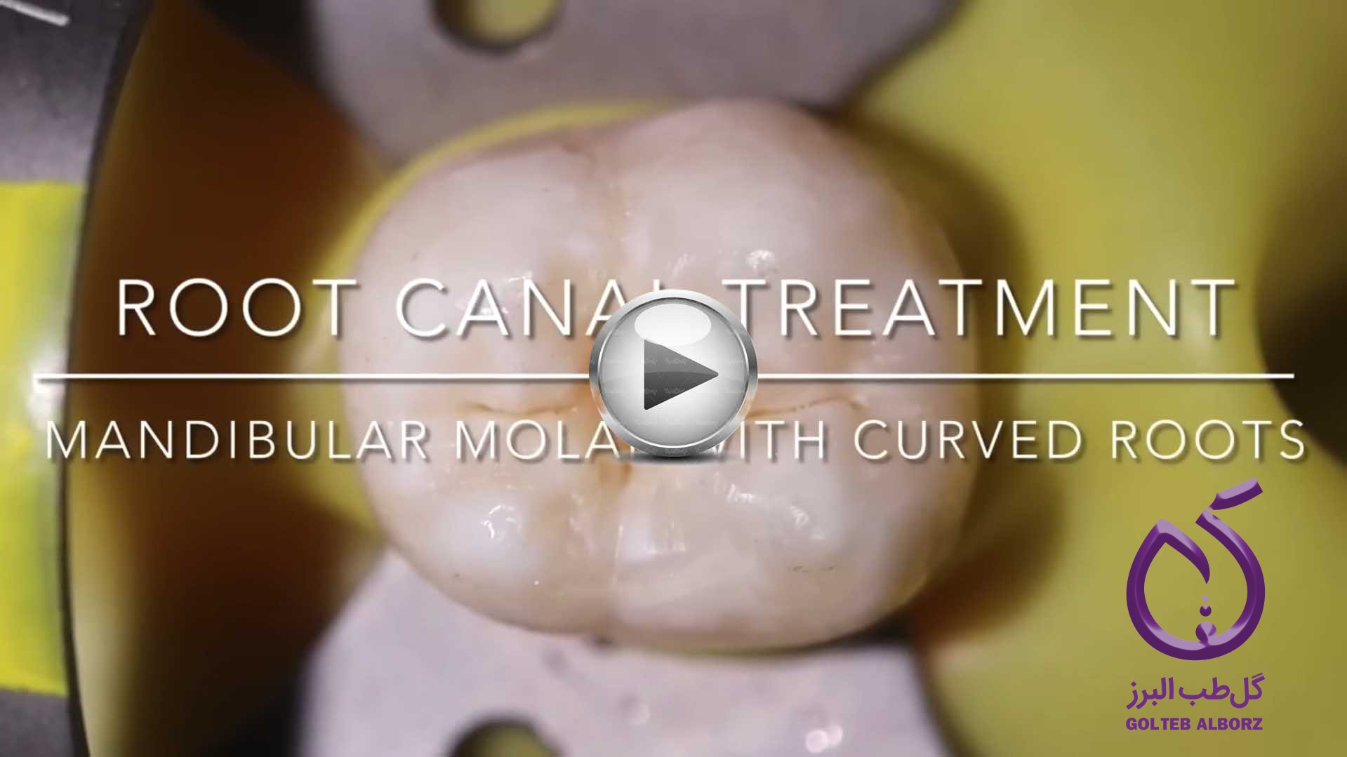 ویدئو تصویری درمان اندو در دندان آسیای پایین با کانال‌های متعدد و ریشه‌های خمیده